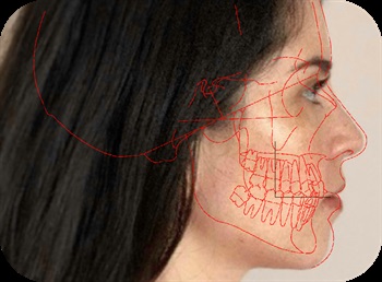 Bolton Cephalometric Standards Template System Now Digitally Available