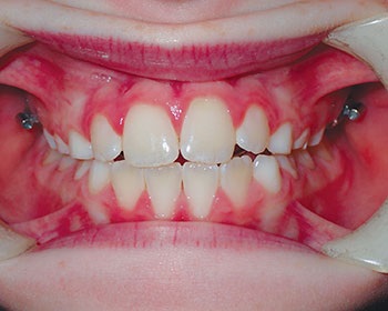 CE: Phase I Treatment