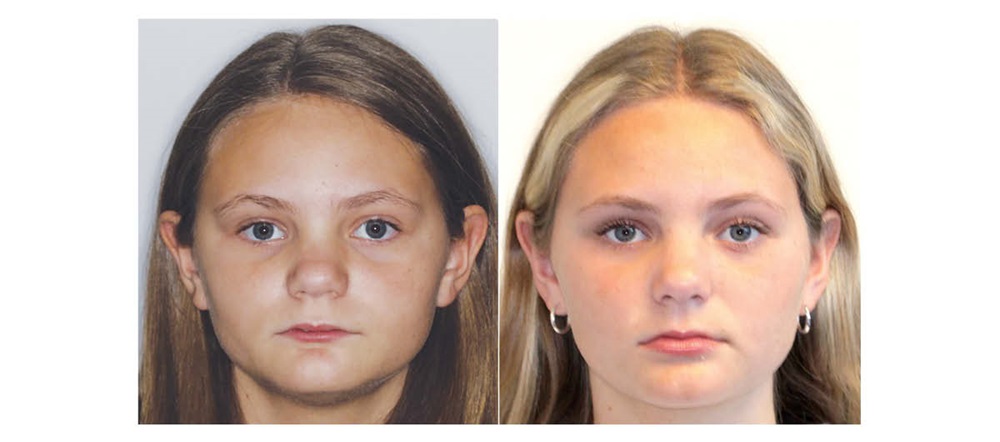 ‘Short-Face’ Patients—Part 3