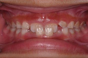 Managing a Simple Anterior Crossbite