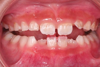 Managing a Simple Anterior Crossbite