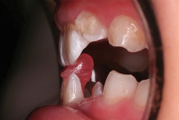 Managing a Simple Anterior Crossbite