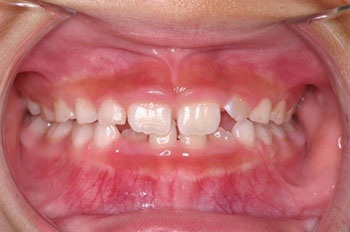 Managing a Simple Anterior Crossbite