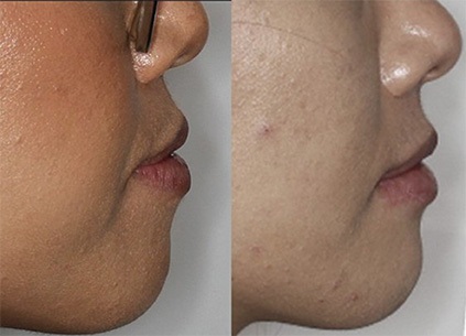 The Architects of the Lips: Part 2