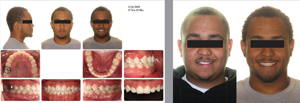 before and after pictures of male patient cont.