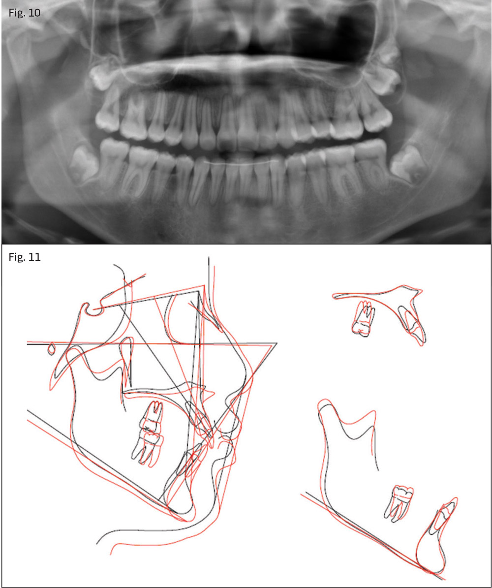 Figs 10 and 11