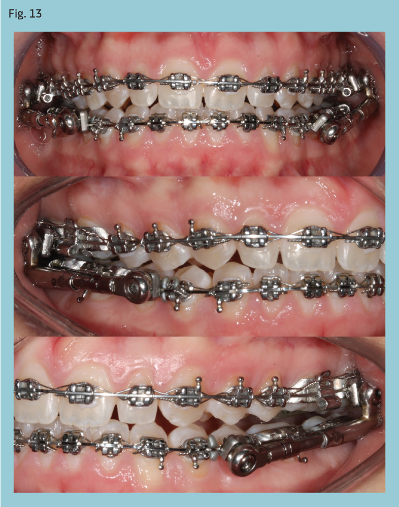 Simplified Correction of Class II Using PowerScope by Alexandre Moro