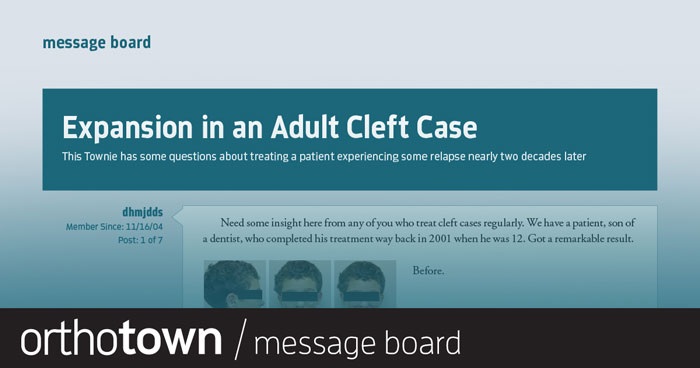 Expansion in an Adult Cleft Case