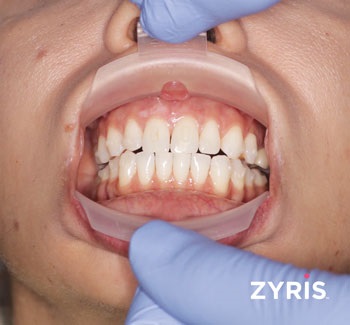 Zyris Dental Retractor