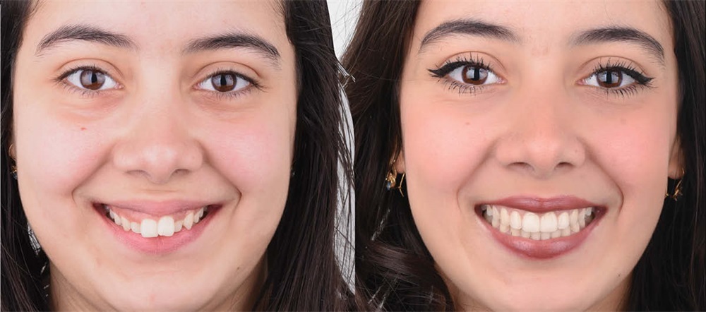 Occlusal Plane Control