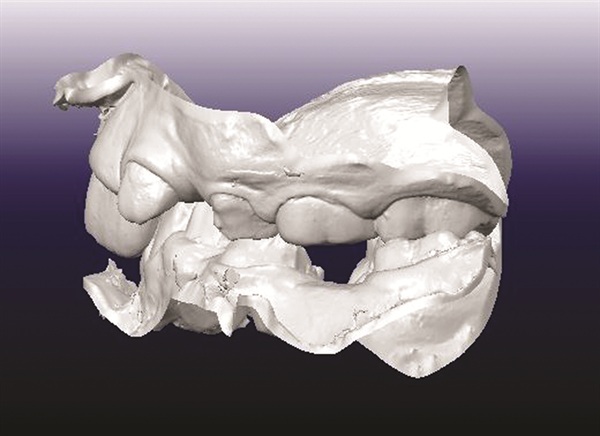 Treating Severe Class II Deep Bite in a 12-Year-Old