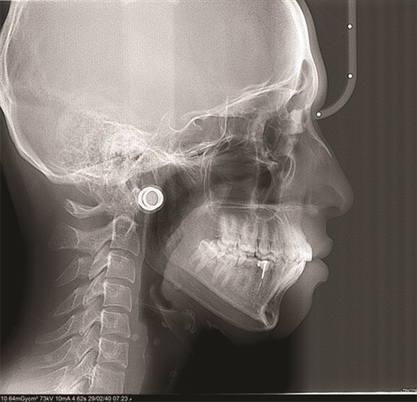 Managing Asymmetry in an Adult Skeletal Class II Patient