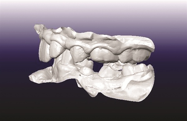 Treating Severe Class II Deep Bite in a 12-Year-Old