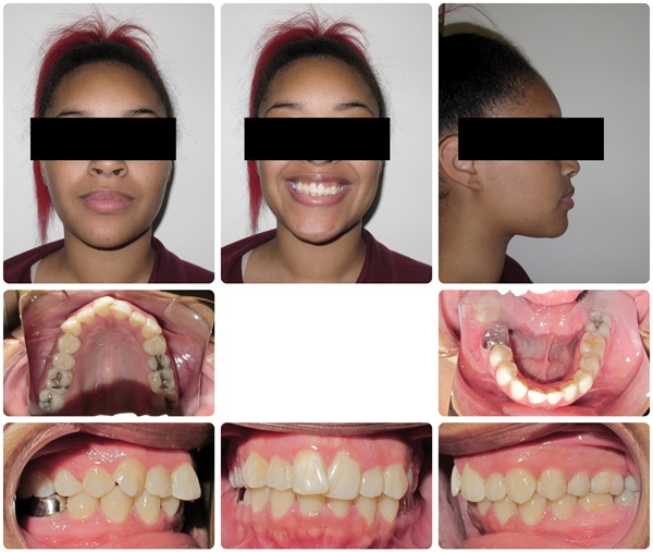 Managing Missing Lower Incisors with Significant Bolton Excess