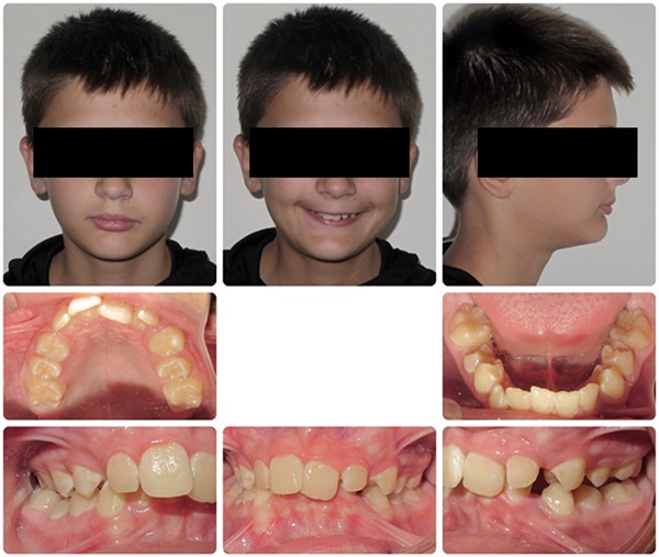 Treating Severe Class II Deep Bite in a 12-Year-Old