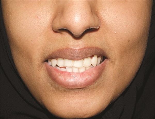 Managing Asymmetry in an Adult Skeletal Class II Patient