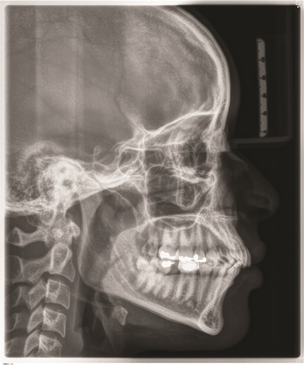 Managing Missing Lower Incisors with Significant Bolton Excess