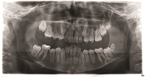 Treating Severe Class II Deep Bite in a 12-Year-Old