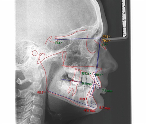 Treating Severe Class II Deep Bite in a 12-Year-Old