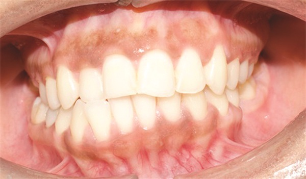 Managing Asymmetry in an Adult Skeletal Class II Patient