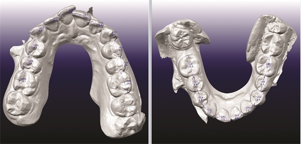 Managing Missing Lower Incisors with Significant Bolton Excess