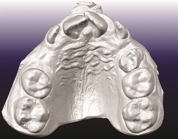 Treating Severe Class II Deep Bite in a 12-Year-Old