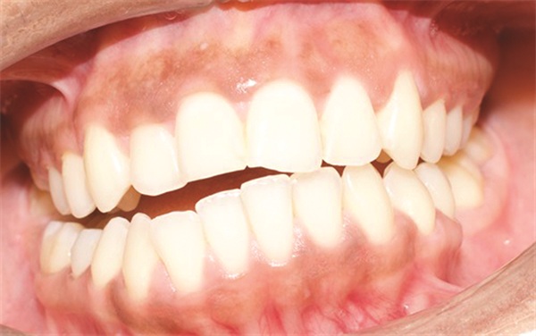 Managing Asymmetry in an Adult Skeletal Class II Patient