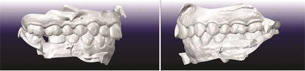 Managing Missing Lower Incisors with Significant Bolton Excess