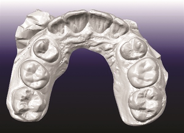 Treating Severe Class II Deep Bite in a 12-Year-Old