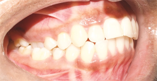 Managing Asymmetry in an Adult Skeletal Class II Patient