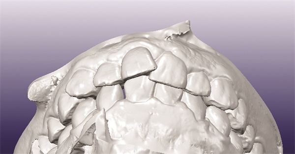 Managing Missing Lower Incisors with Significant Bolton Excess