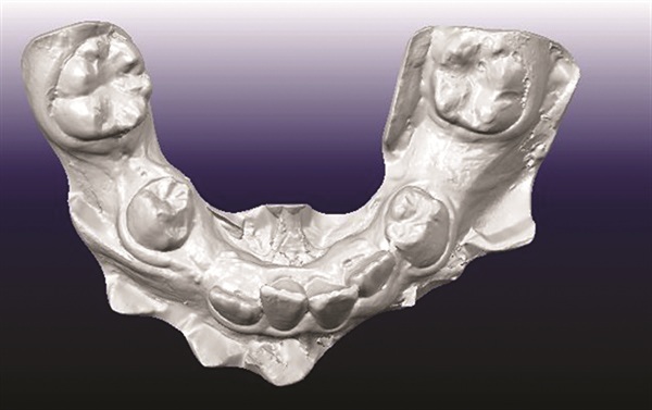 Treating Severe Class II Deep Bite in a 12-Year-Old