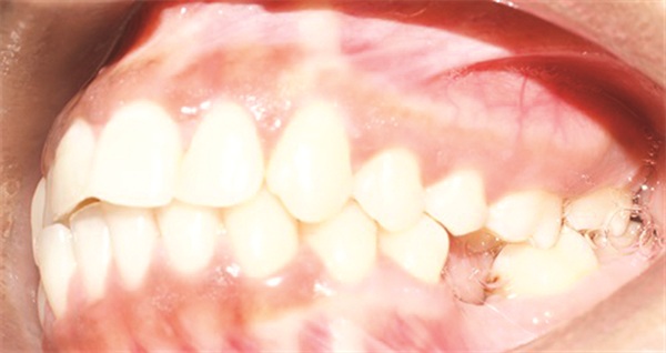 Managing Asymmetry in an Adult Skeletal Class II Patient
