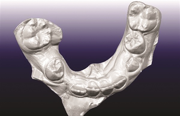 Treating Severe Class II Deep Bite in a 12-Year-Old