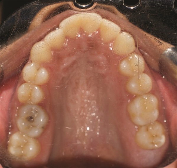 Managing Asymmetry in an Adult Skeletal Class II Patient