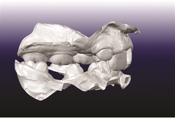 Treating Severe Class II Deep Bite in a 12-Year-Old