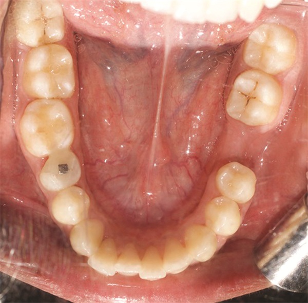 Managing Asymmetry in an Adult Skeletal Class II Patient