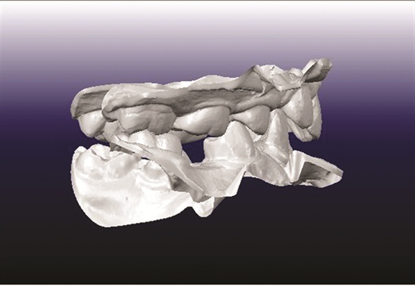 Treating Severe Class II Deep Bite in a 12-Year-Old