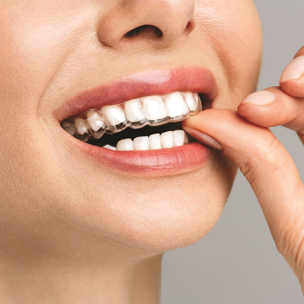 DreamAligners Clear Aligners
