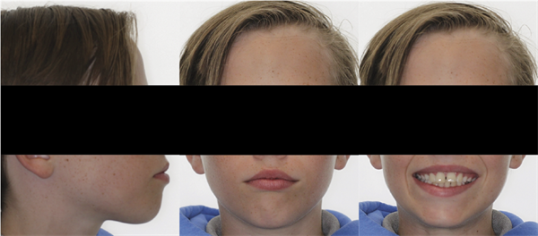 Thinking Outside the Aligner