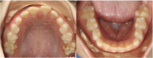 Thinking Outside the Aligner