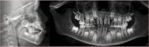 Thinking Outside the Aligner