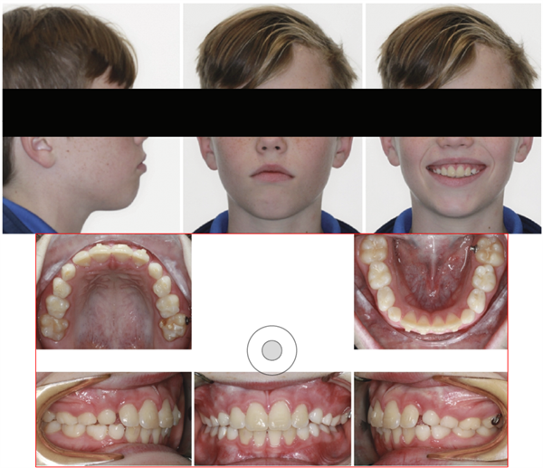 Thinking Outside the Aligner