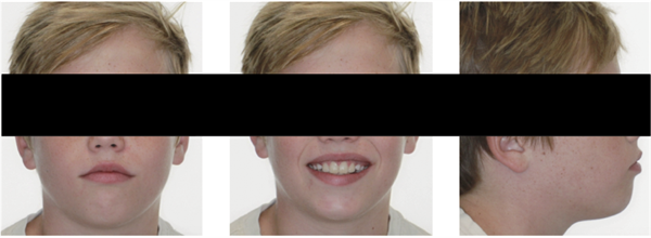 Thinking Outside the Aligner