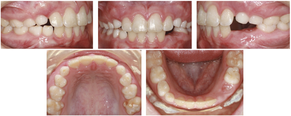 Thinking Outside the Aligner