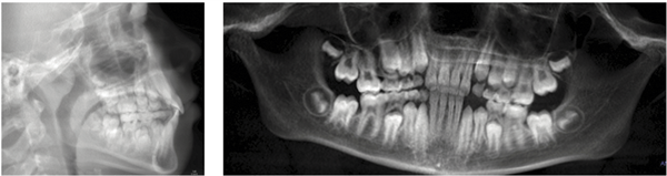 Thinking Outside the Aligner