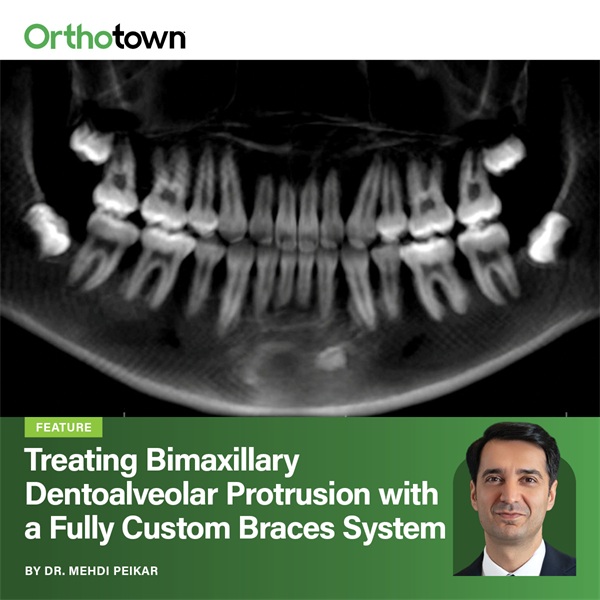 Treating Bimaxillary Dentoalveolar Protrusion with a Fully Custom Braces System