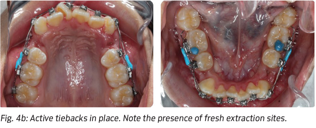 JCDR - Alignment, Canine lacebacks, Incisor crowding, Open coil springs,  Sliding mechanics