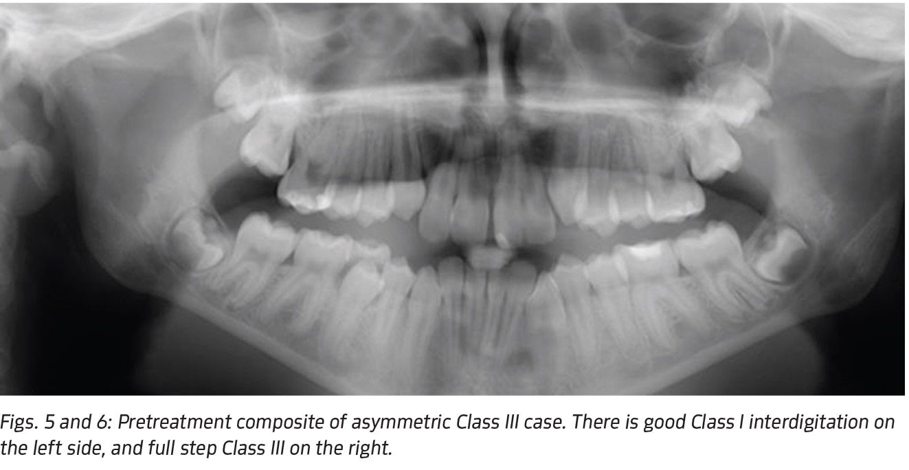 Little Effort, Big Results by Andrew Hayes, DDS - Orthotown