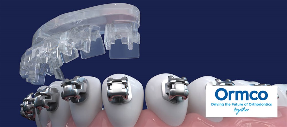 Product Profile: Ormco Digital Bonding